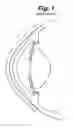 Fig. 02 - Partial corneal conjunctival contact lens