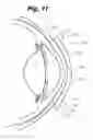 Fig. 08 - Partial corneal conjunctival contact lens
