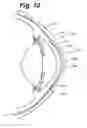 Fig. 09 - Partial corneal conjunctival contact lens