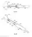 Fig. 09 - Endocavitary ultrasound probe with biopsy system having two needle guides