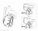 Fig. 01 - Treatment of appendage openings