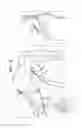 Fig. 03 - Treatment of appendage openings
