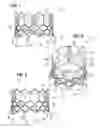Fig. 02 - Prosthetic heart valve
