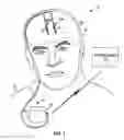 Fig. 02 - Therapeutic window determination