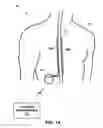 Fig. 02 - Programming posture responsive therapy