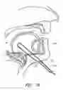 Fig. 27 - Methods for hyoid suspension