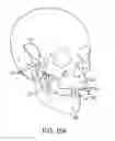 Fig. 20 - Orthognathic biomechanical simulation