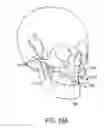 Fig. 22 - Orthognathic biomechanical simulation