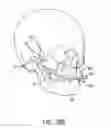 Fig. 23 - Orthognathic biomechanical simulation