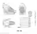 Fig. 09 - Computer-assisted face-jaw-teeth transplantation