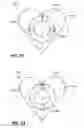 Fig. 14 - Orthodontic appliance