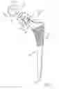 Fig. 04 - Modular taper seal for orthopaedic prosthetic hip assembly
