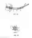 Fig. 02 - Echogenic Indwelling Catheter