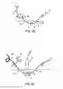Fig. 07 - Echogenic Indwelling Catheter