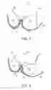 Fig. 06 - Post-surgical support brassiere
