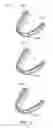 Fig. 17 - Systems, apparatuses and methods for dental appliances with integrally formed features