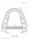 Fig. 22 - Direct fabrication of aligners for arch expansion
