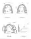 Fig. 09 - Direct fabrication of attachment templates with adhesive