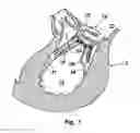 Fig. 02 - Arrangement, a loop-shaped support, a prosthetic heart valve and a method of repairing or replacing a native heart valve