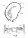 Fig. 03 - Arrangement, a loop-shaped support, a prosthetic heart valve and a method of repairing or replacing a native heart valve
