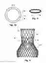 Fig. 04 - Arrangement, a loop-shaped support, a prosthetic heart valve and a method of repairing or replacing a native heart valve