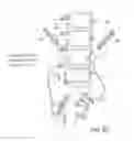 Fig. 65 - Systems, device, and methods for joint fusion