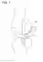Fig. 08 - Internal joint cavity expander