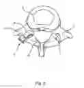 Fig. 07 - Linked Bilateral Spinal Facet Implants and Methods of Use