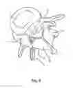 Fig. 09 - Linked Bilateral Spinal Facet Implants and Methods of Use