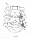 Fig. 35 - Linked Bilateral Spinal Facet Implants and Methods of Use