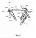Fig. 72 - Linked Bilateral Spinal Facet Implants and Methods of Use