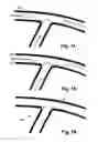 Fig. 07 - Stent system, deployment apparatus and method for bifurcated lesion
