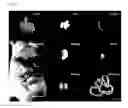 Fig. 15 - SONOSENSITIZER COMPOSITION CONTAINING TITANIUM OXIDE NANOPARTICLE AS ACTIVE INGREDIENT, COMPOSITION FOR PREVENTING OR TREATING CANCER COMPRISING THE SAME, AND THE PREPARATION THEREOF