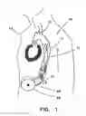 Fig. 02 - ENDOVASCULAR COMPLIANCE ASSEMBLY