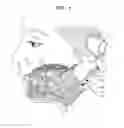 Fig. 02 - Method for symmetry-based implant control