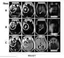 Fig. 02 - Methods for the treatment of vascularizing cancers
