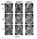 Fig. 07 - Methods for the treatment of vascularizing cancers