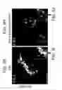 Fig. 18 - DOWNREGULATION OF miR-7 FOR PROMOTION OF BETA CELL DIFFERENTIATION AND INSULIN PRODUCTION