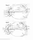 Fig. 06 - Means for controlling the progression of myopia