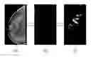 Fig. 01 - Generating a synthetic two-dimensional mammogram