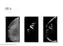 Fig. 04 - Generating a synthetic two-dimensional mammogram