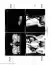 Fig. 12 - Methods and systems for three-dimensional visualization of deviation of volumetric structures with colored surface structures