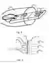 Fig. 04 - Hearing device with detachable speaker unit