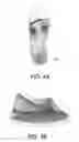 Fig. 07 - METHODS FOR DESIGNING A FOOT ORTHOTIC