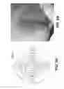 Fig. 13 - Apparatus and methods for determining damaged tissue using sub-epidermal moisture measurements