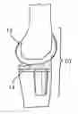 Fig. 01 - SYSTEMS AND METHODS FOR PROVIDING A FEMORAL RESECTION BLOCK
