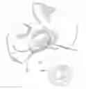 Fig. 01 - Patient-specific total hip arthroplasty