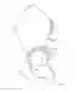 Fig. 09 - Patient-specific total hip arthroplasty