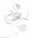 Fig. 11 - Patient-specific total hip arthroplasty