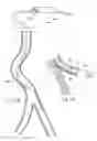 Fig. 28 - ATHERECTOMY DEVICES, SYSTEMS, AND METHODS